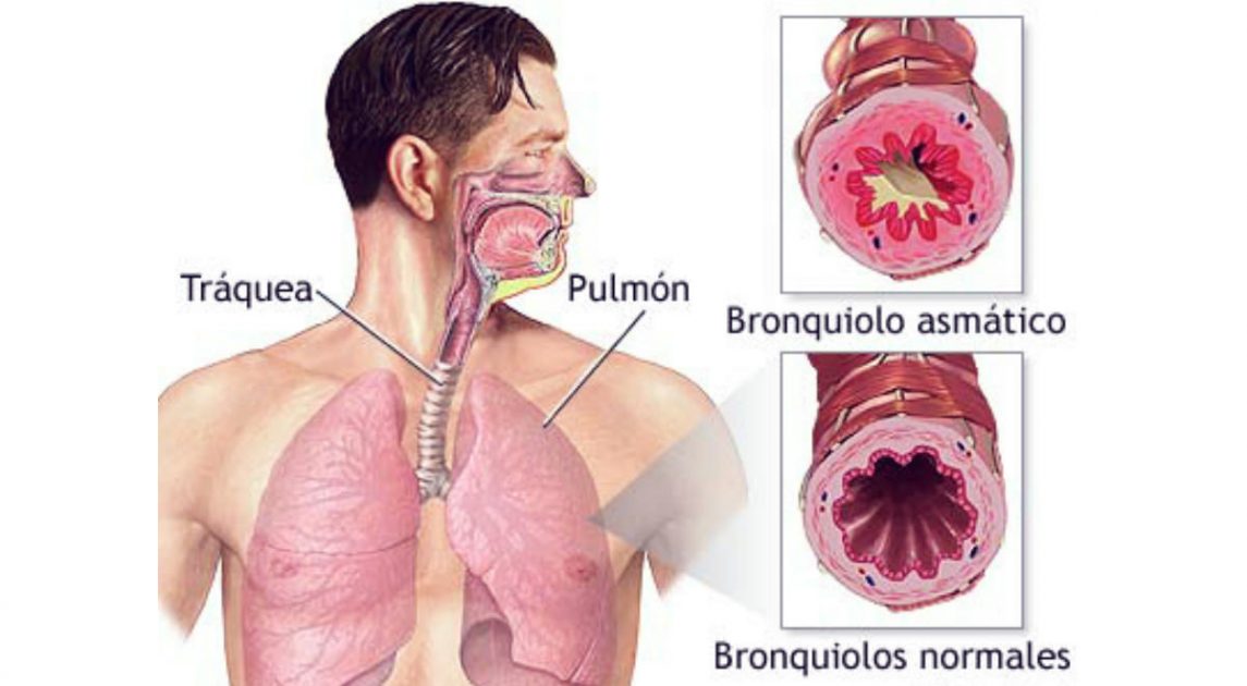 Bronquitis Asmática